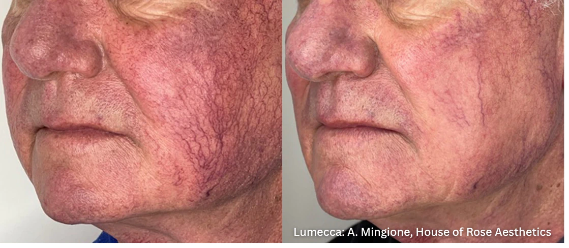 Side-by-side Lumecca photographs credited to A. Mingione, House of Rose Aesthetics