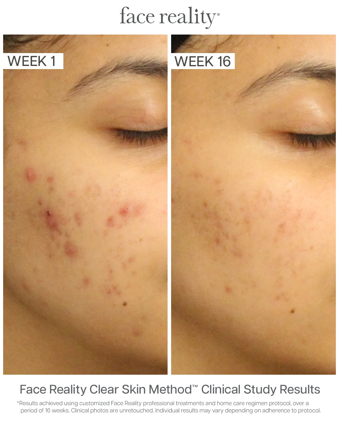 Face Reality Clear Skin Method clinical results — acne before (Week 1) and after (Week 16), case 1