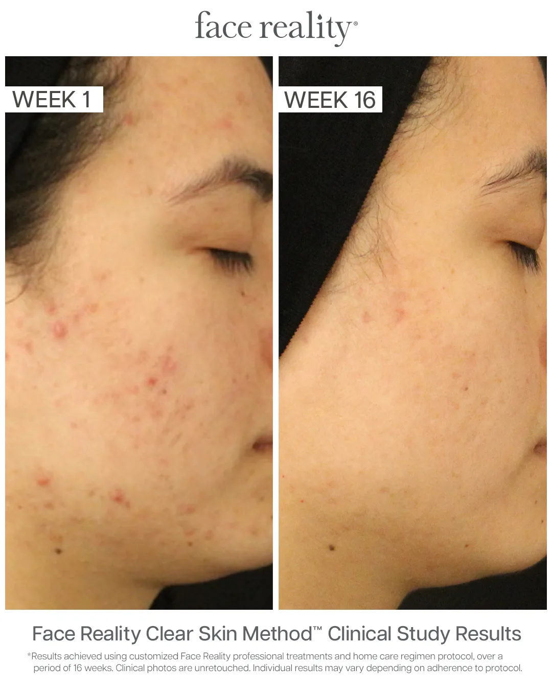 Face Reality Clear Skin Method clinical results — acne before (Week 1) and after (Week 16), case 2
