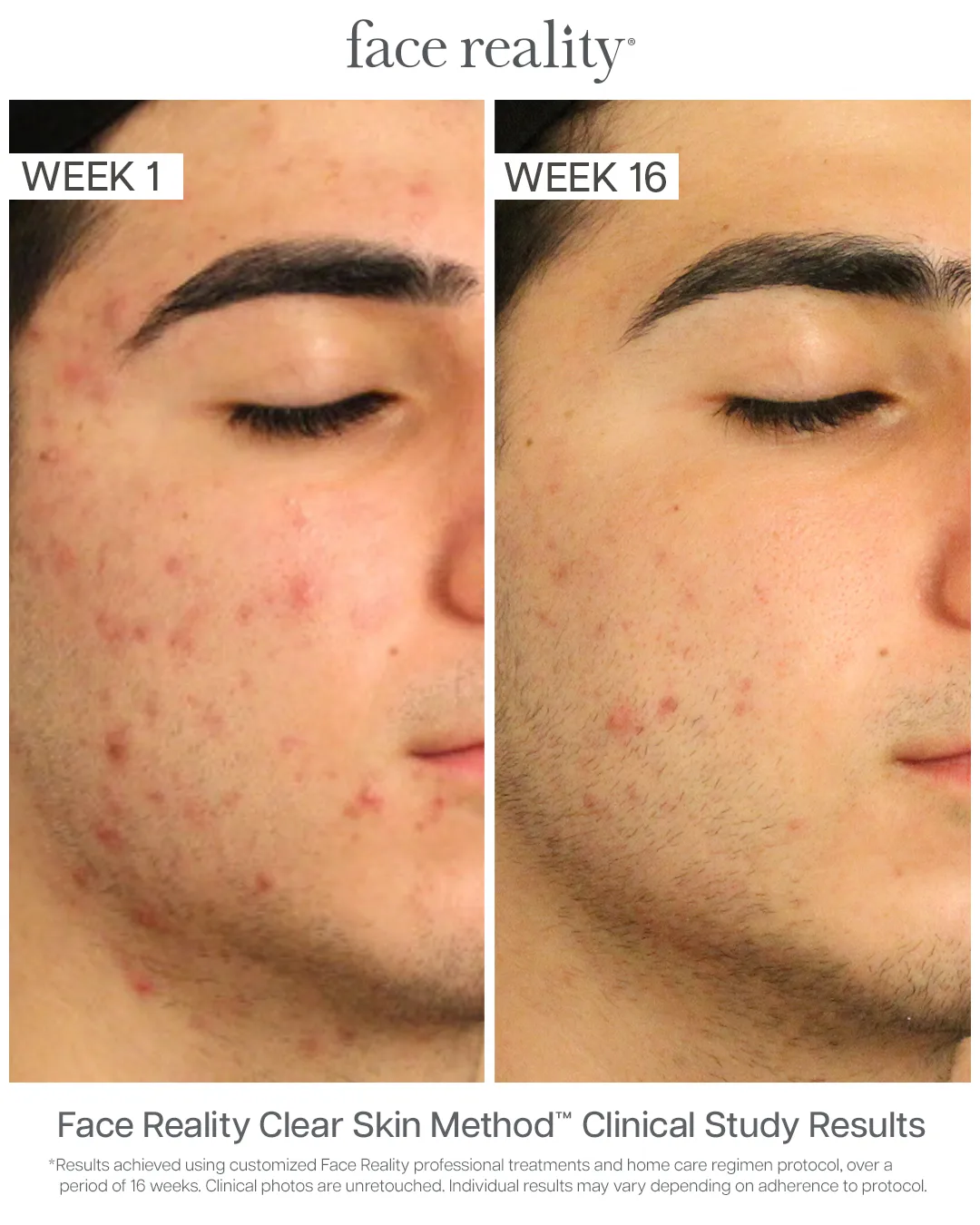 Face Reality Clear Skin Method clinical results — acne before (Week 1) and after (Week 16), case 3