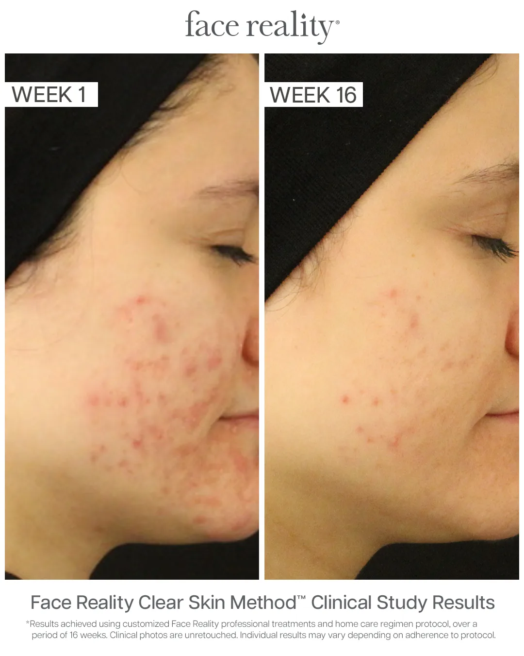 Face Reality Clear Skin Method clinical results — acne before (Week 1) and after (Week 16), case 4