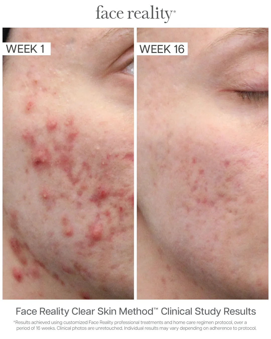 Face Reality Clear Skin Method clinical results — acne before (Week 1) and after (Week 16), case 5
