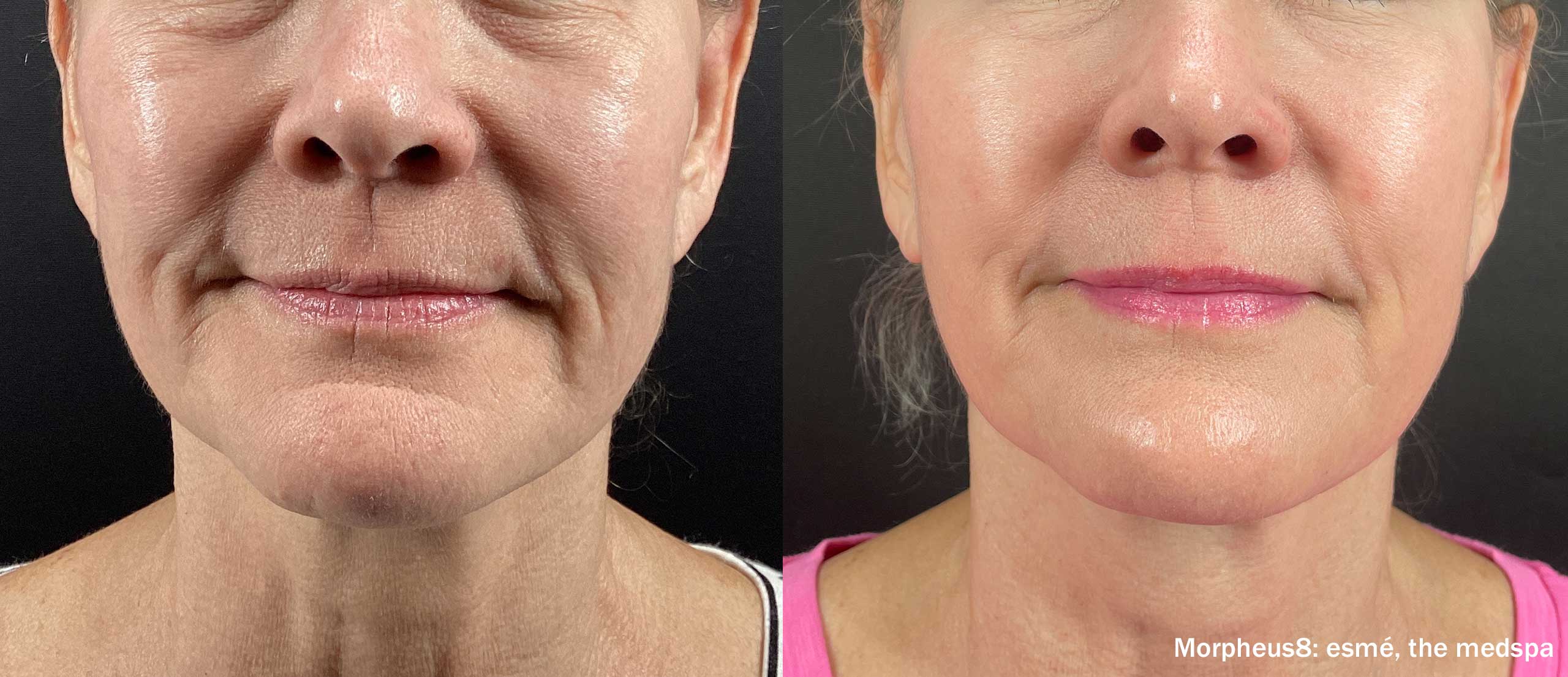 Manufacturer-provided facial Morpheus8 before and after example
