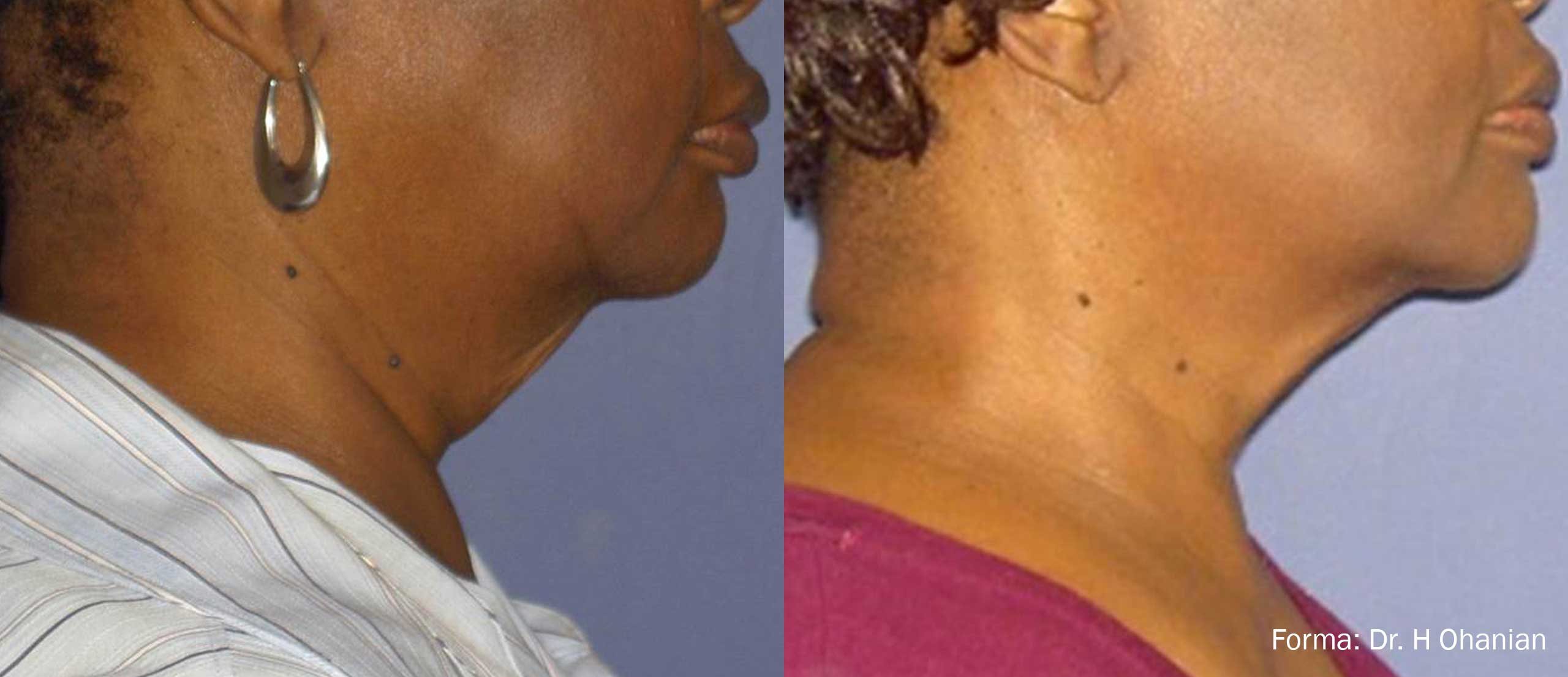 Manufacturer-provided Forma facial profile before and after example