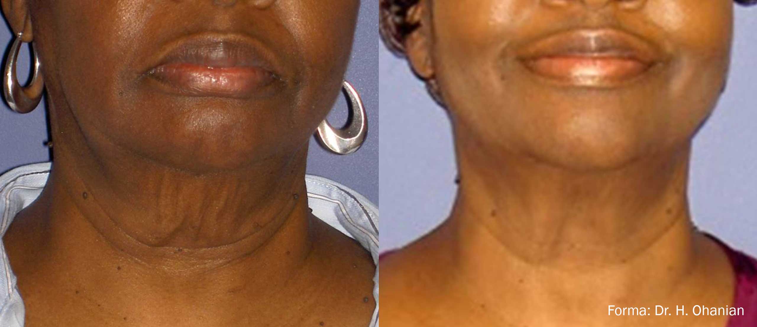 Manufacturer-provided Forma facial front-view before and after example