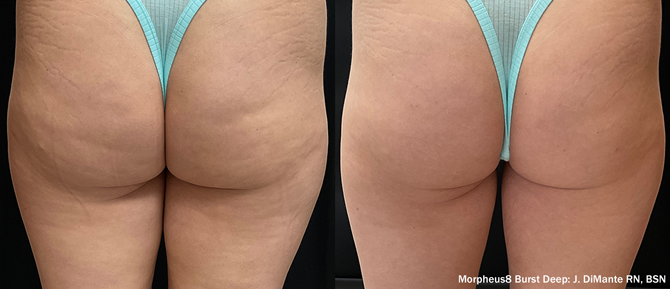 Manufacturer-provided Morpheus8 before and after example for the buttocks