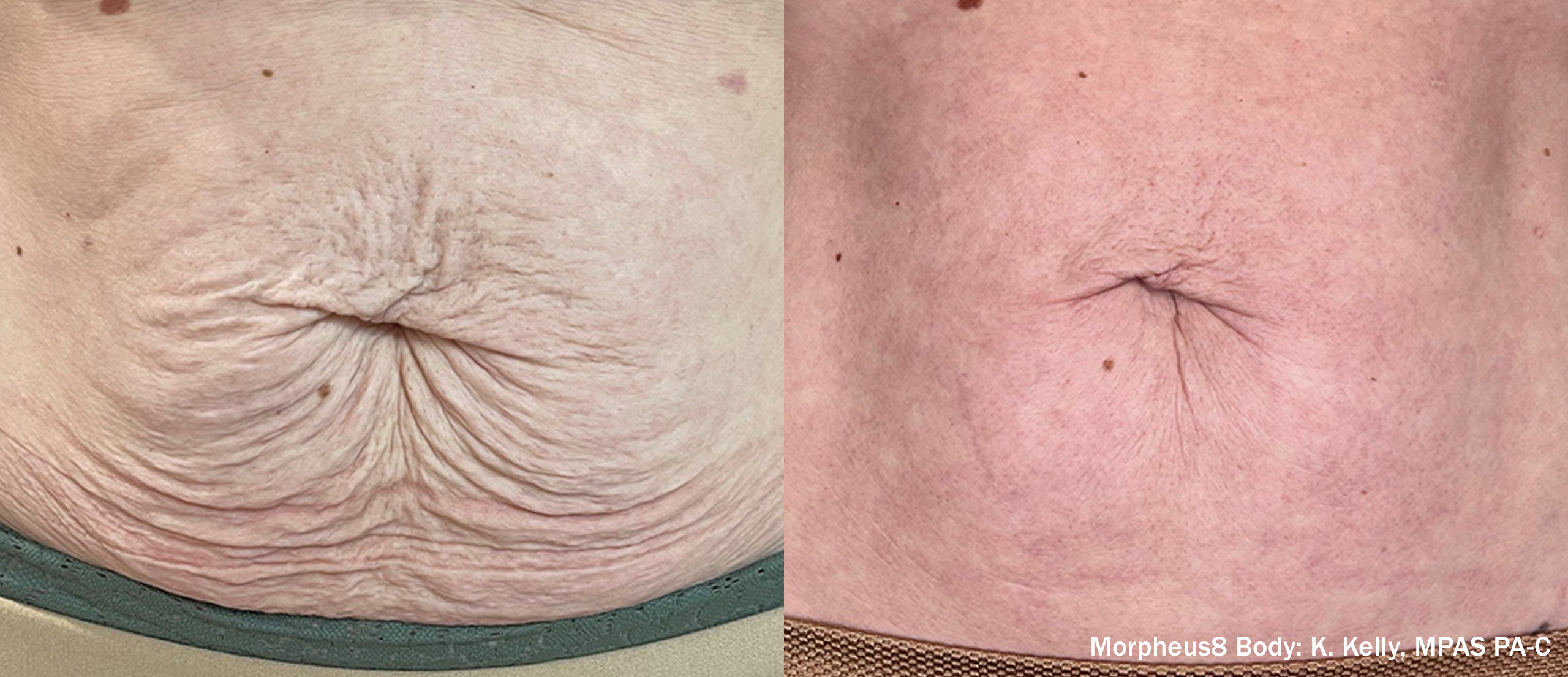 Manufacturer-provided abdominal Morpheus8 before and after example