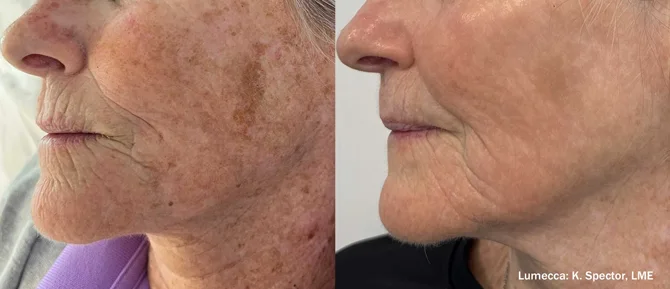 Manufacturer-provided Lumecca Peak facial before and after showing visible brown pigmentation