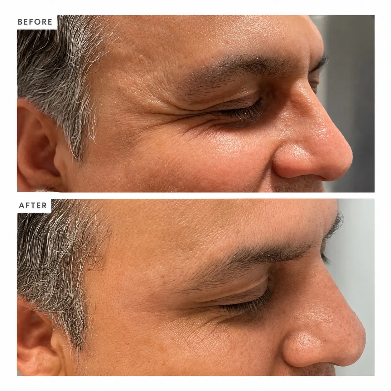 Botox before-and-after comparison; before above, after below