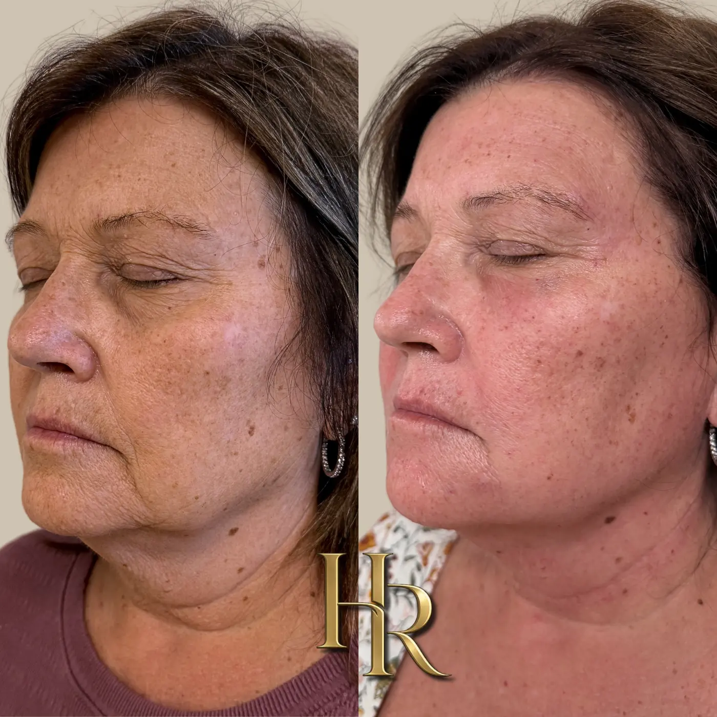 Morpheus8, PRF and Lumecca Peak IPL before-and-after comparison at House of Rose