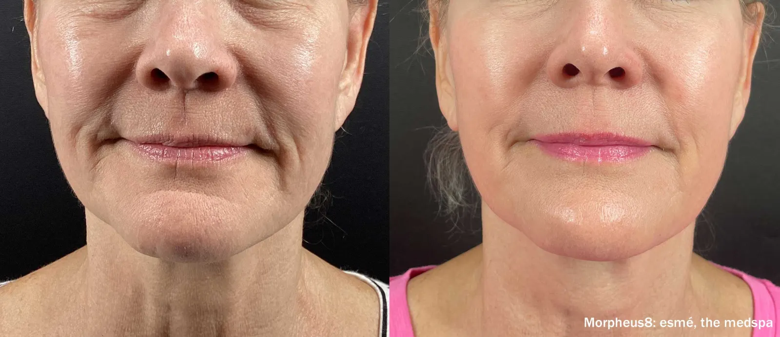 Manufacturer-provided Morpheus8 facial before and after showing the lower face after four treatments