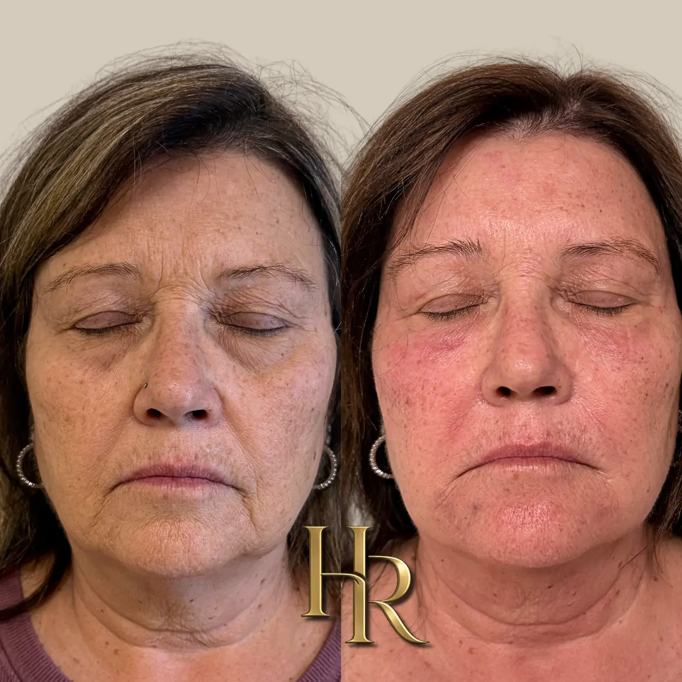 Morpheus8, PRF and Lumecca Peak IPL before-and-after comparison at House of Rose